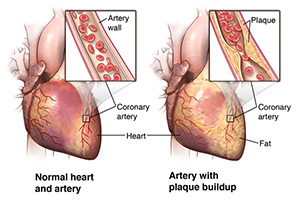 Illustration of the heart and arteries, as well as plaque build-up in arterial wall