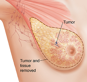 Three-quarter view of female underarm area showing breast anatomy ghosted in. Outline around tissue for simple mastectomy.