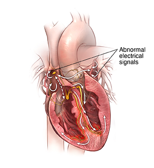 Front view cross section of heart showing arrhythmia.