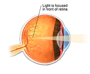 Cross section of eye showing myopia, with light focusing in front of retina.