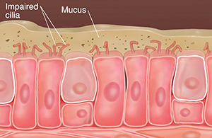 Cells with damaged cilia showing mucus buildup and particles in mucus.