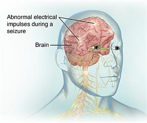 Side view of head showing brain with abnormal electrical impulses. 