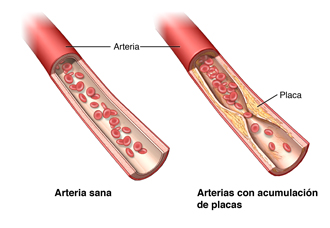 Una arteria normal y una dañada