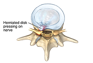 Top view of lumbar vertebra with a herniated disk.