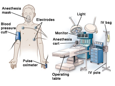 Outline of child with anesthesia mask on face, blood pressure cuff on upper arm, pulse oximeter cuff on finger, and electrodes on chest. Operating room in background shows operating table, IV pole, IV bag, anesthesia cart, monitor, and light.